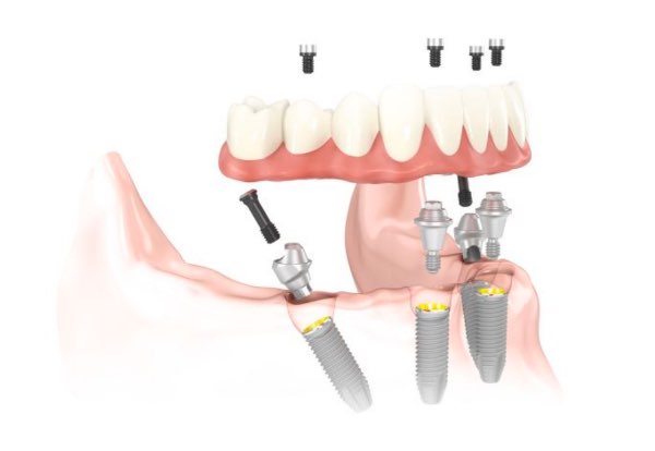 all on four denture implants