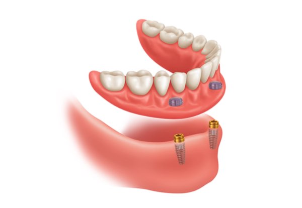 snap in denture implants