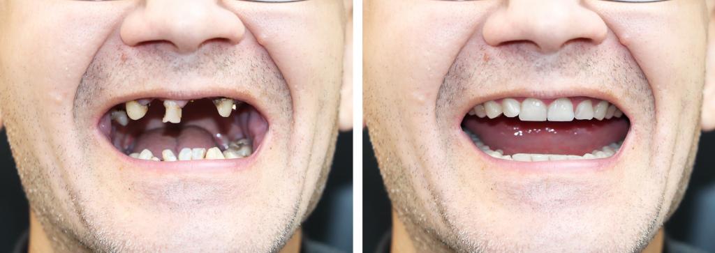 Dentures Before And After Pictures Of Patients European Denture Center