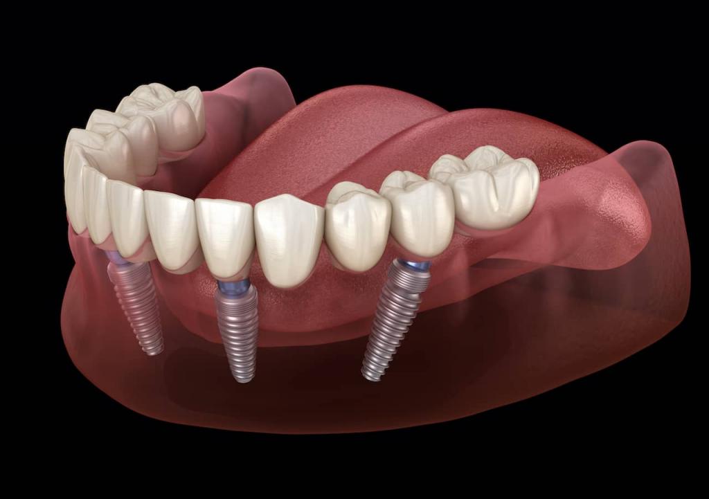 Implant Supported Dentures Cost  