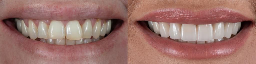 dentures before and after