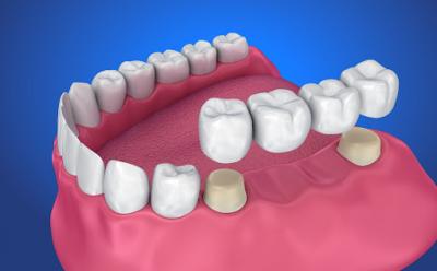 tooth replacement options