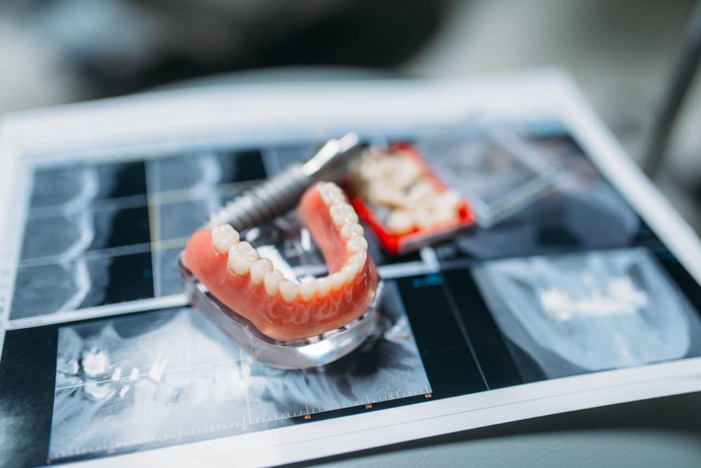 Dental implants set on top of image of x-rays.