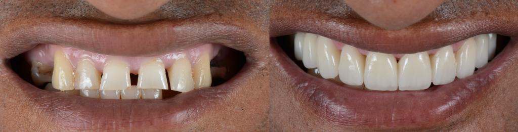 immediate dentures before and after