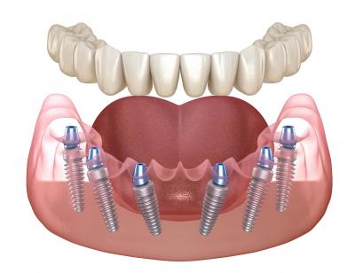 implant-retained vs implant-supported dentures
