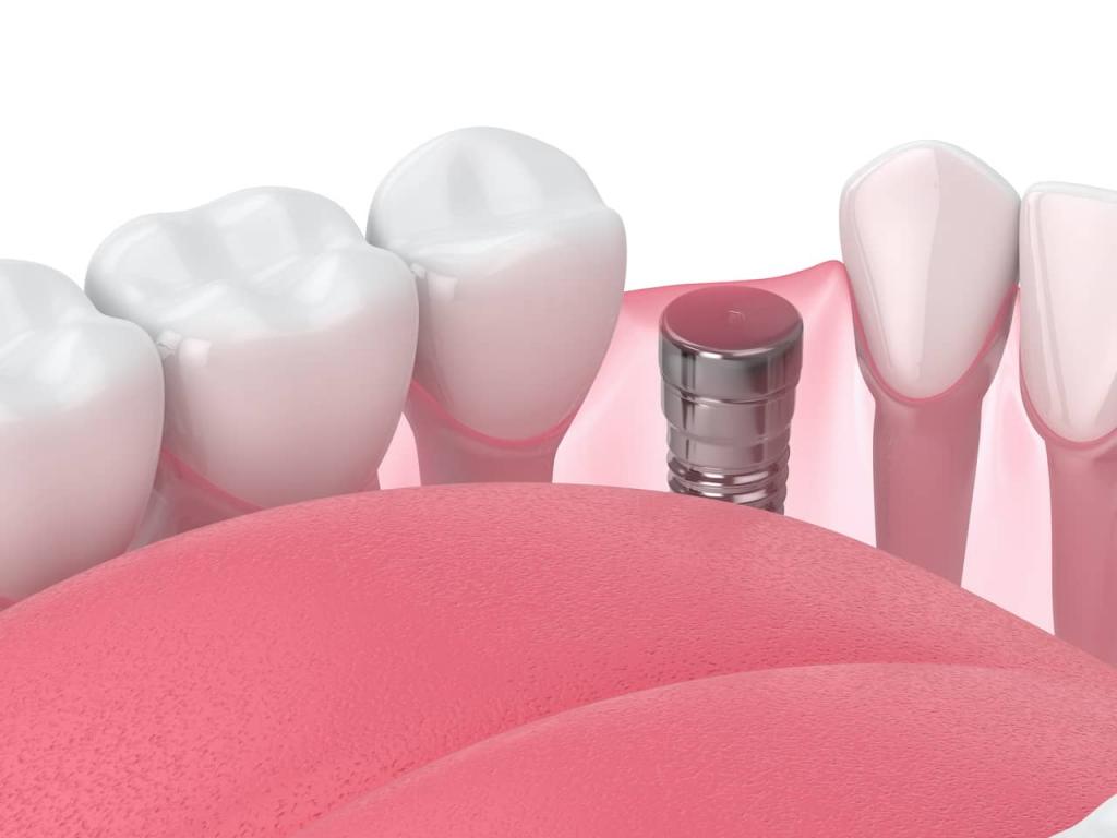 implant retained dentures cost