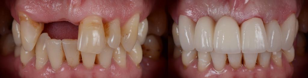 partial denture before and after