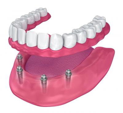 tooth replacement options