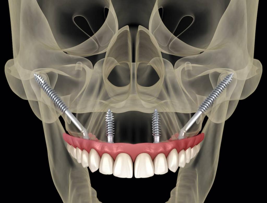 types of dental implants