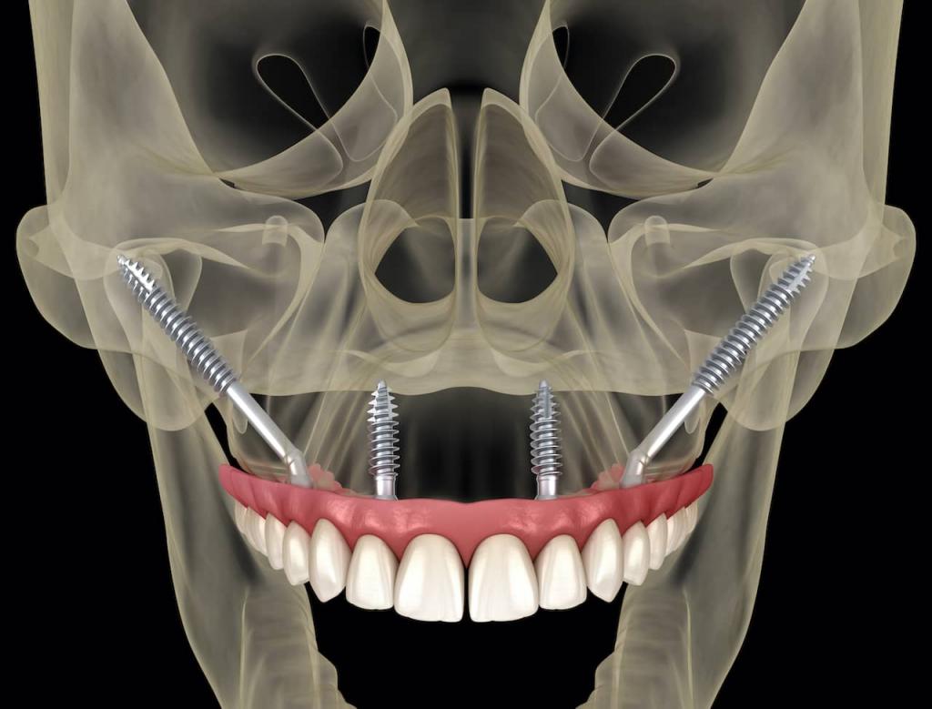 Implant Techniques