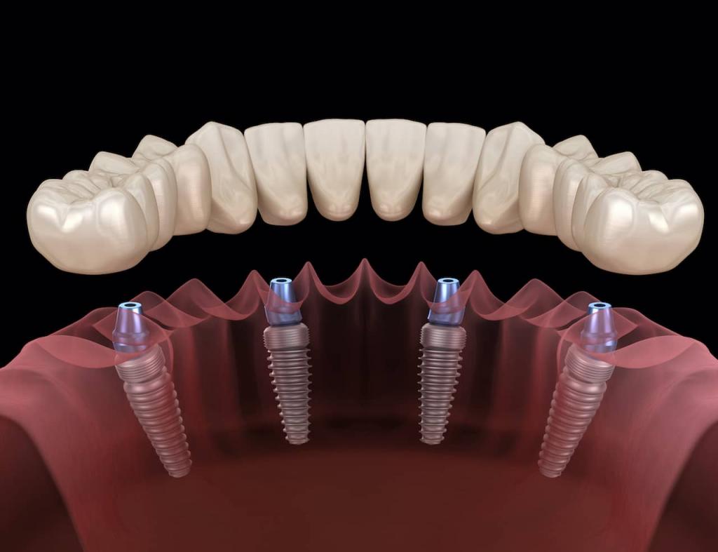 tooth implant types