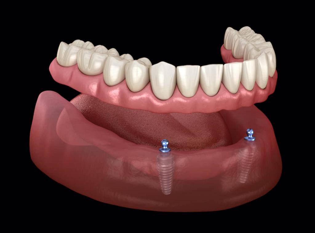types of dental implants