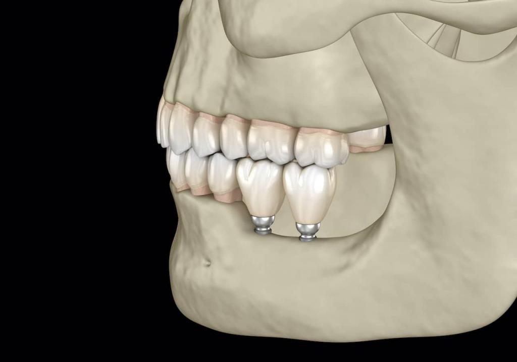 Implant Techniques