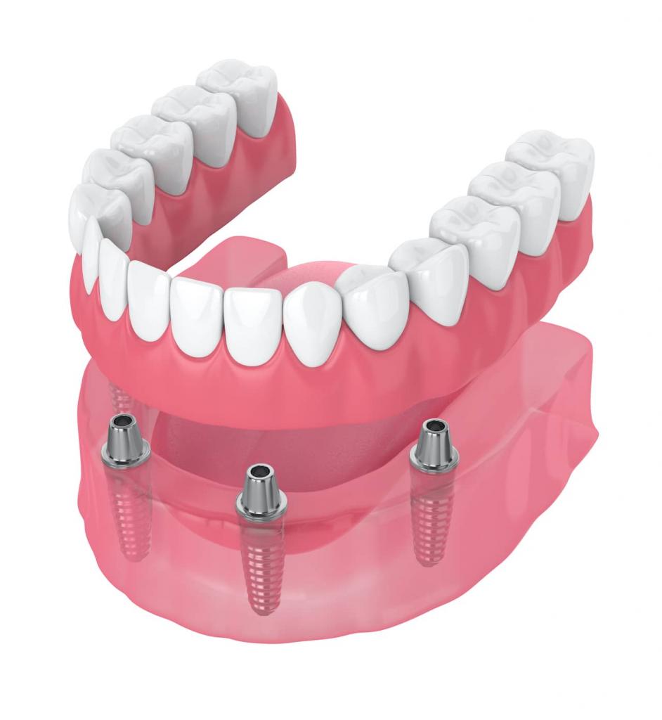 what are implant retained dentures
