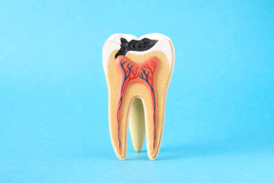 What is tooth decay