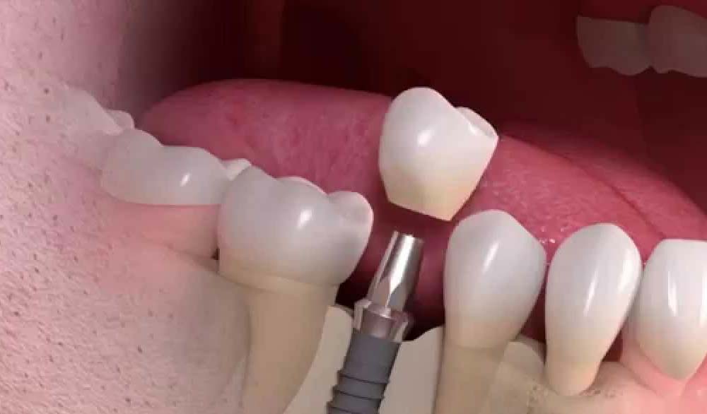 Dental Implants Before and After Cases - Gordon Dental