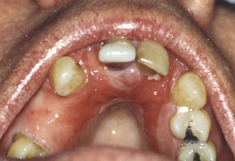 denture stomatitis