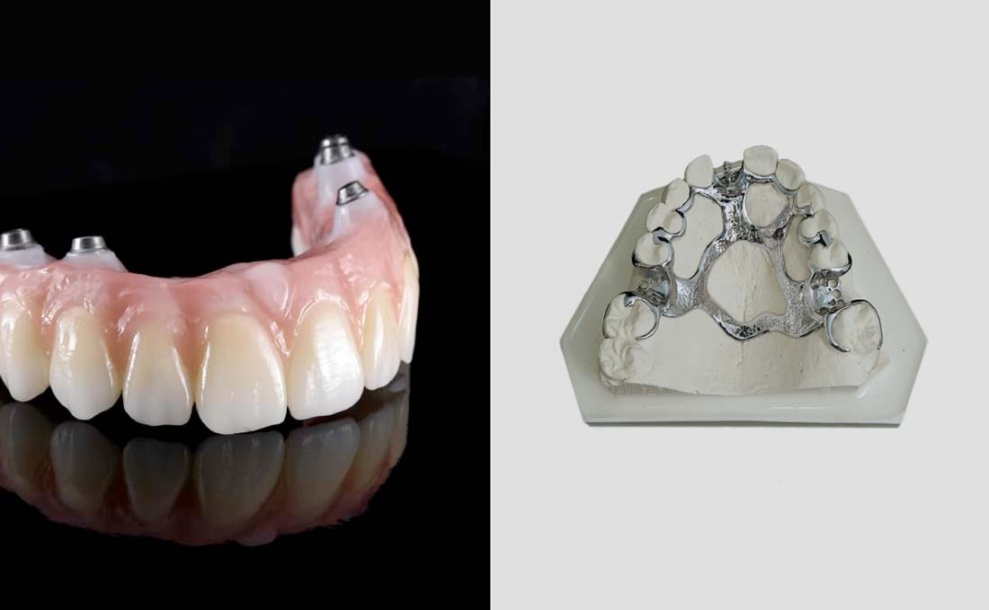 denture implants