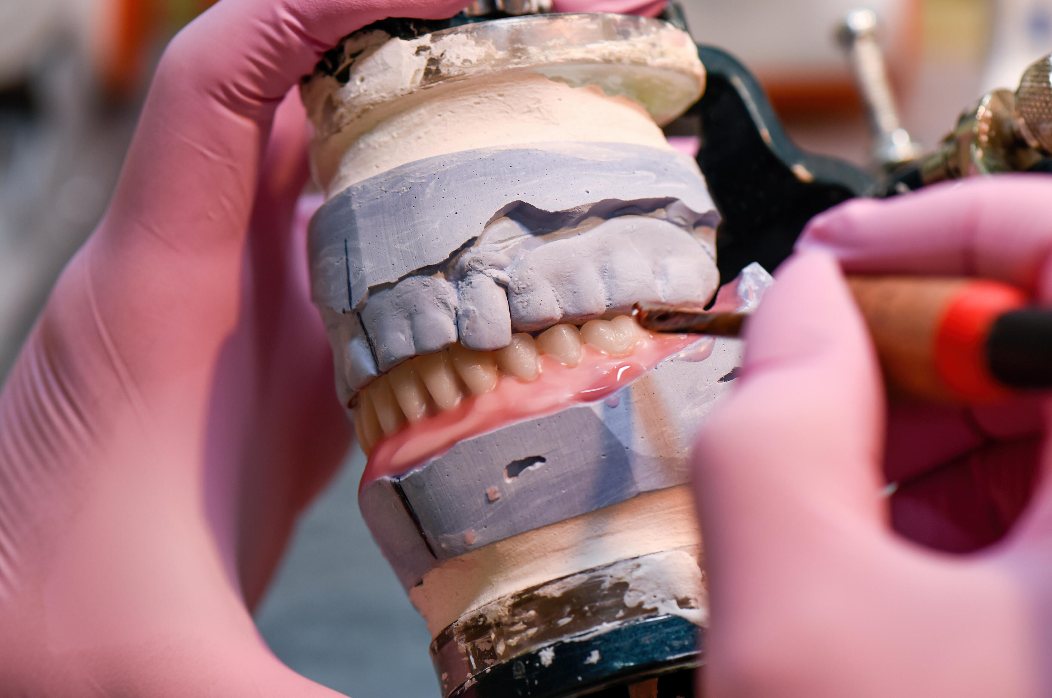 Immediate Denture Steps: Process and How to Plan