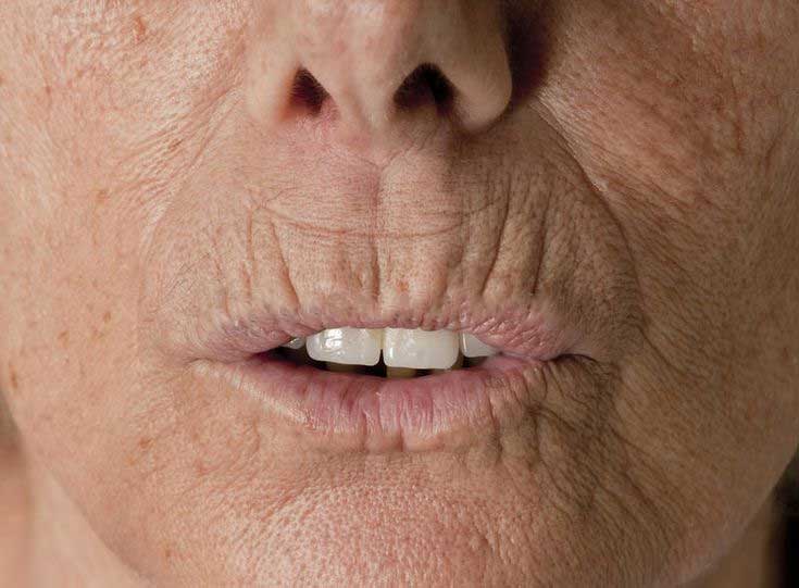 Wrinkled Lips